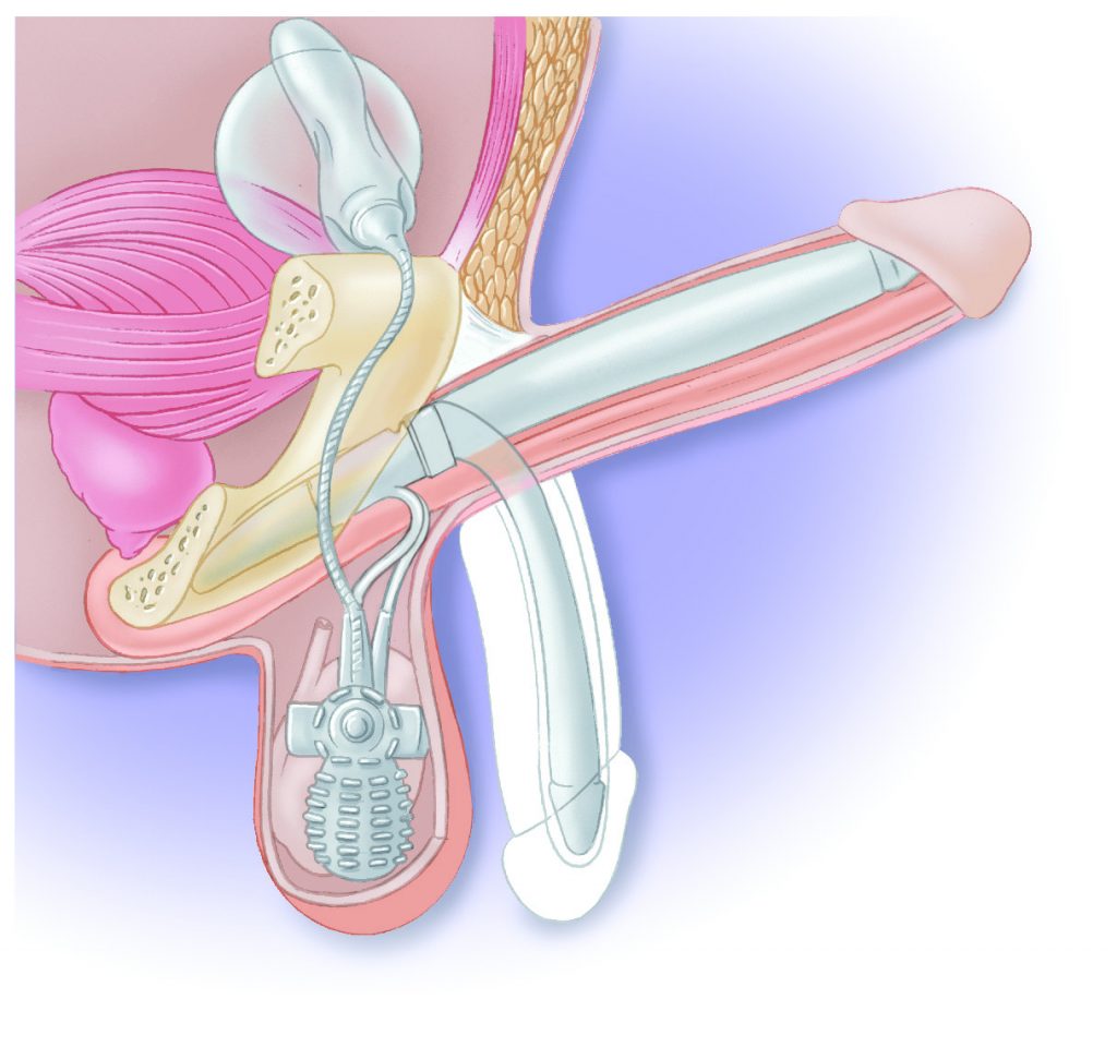 Tratamiento para la Disfunción Eréctil con prótesis