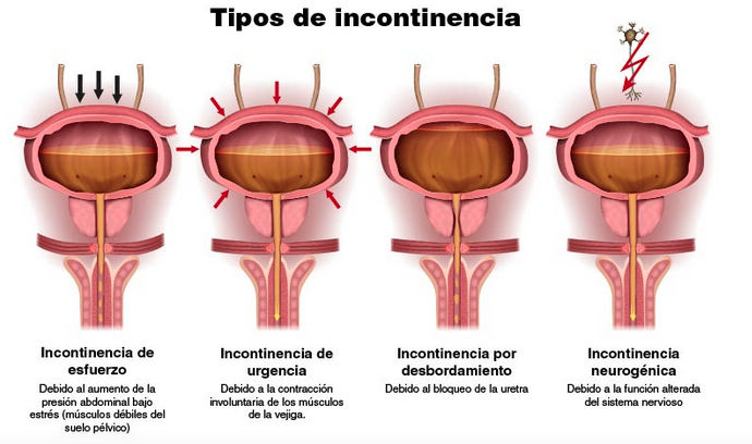Dispositivo médico para la incontinencia urinaria en hombres. HAREX