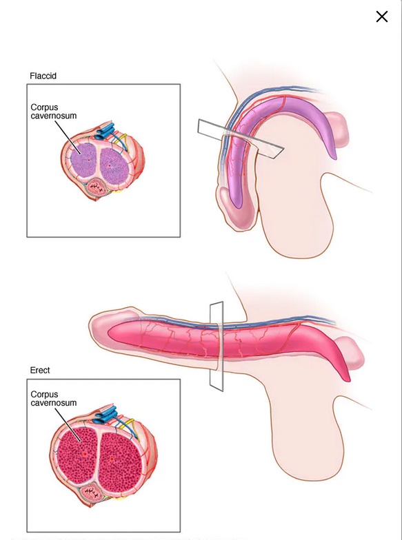Enfermedad de la Peyronie- Curvatura de pene