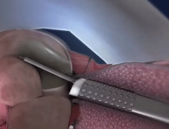 Enucleación prostática con laser