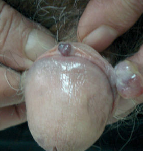 Sarcoma de Kaposi en el pene