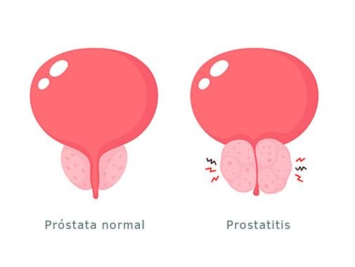 Dr. Alejandro Fernández Larrañaga. ¿Qué es la prostatitis?